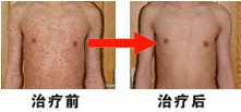 重庆第一人民医院皮肤科皮肤科